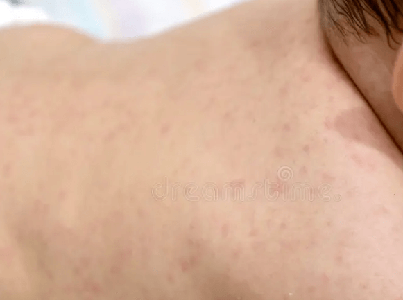 Baby:7sqqnv_Fzis= Chicken Pox