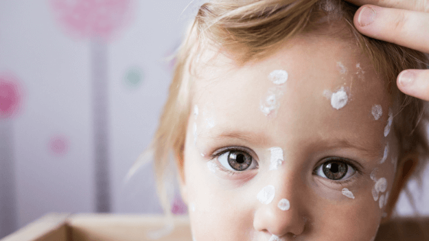 Baby:7sqqnv_Fzis= Chicken Pox