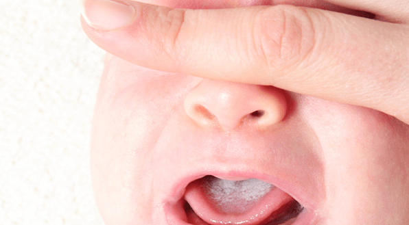 Baby:6a-Tifykgqm= Oral Thrush Symptoms